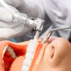 Fogkőeltávolítás Budapest