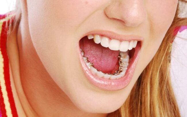 Láthatatlan fogszabályozó