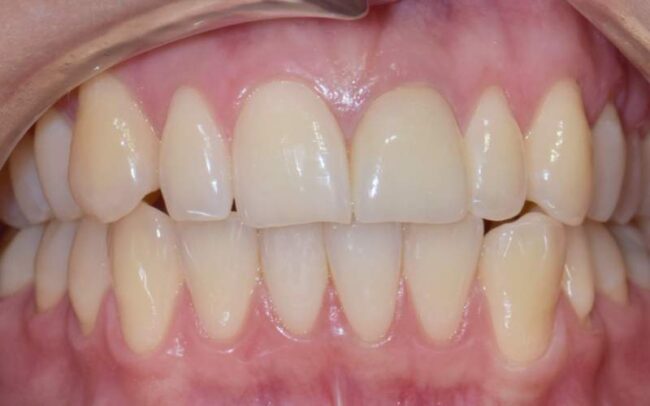 Préskerámia korona után